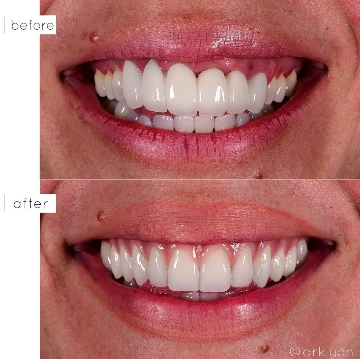 All-on-4 Dental Implants Beverly Hills | Dr. Kiyan Mehdizadeh